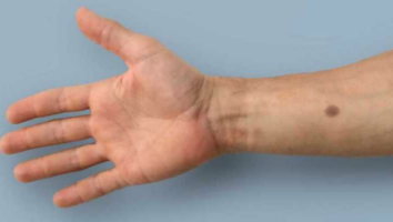 توسعه ایمپلنتی که با ایجاد یک خال روی پوست، ابتلا به سرطان را اطلاع می دهد