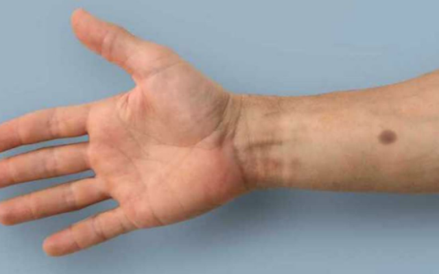 توسعه ایمپلنتی که با ایجاد یک خال روی پوست، ابتلا به سرطان را اطلاع می دهد