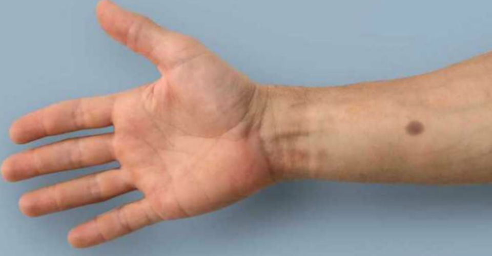 توسعه ایمپلنتی که با ایجاد یک خال روی پوست، ابتلا به سرطان را اطلاع می دهد